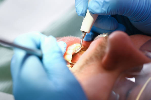 Best Emergency Root Canal Therapy in Country Clu, MO